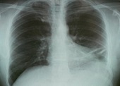 Przyczyny oraz grupy ryzyka przewlekłej obturacyjnej choroby płuc