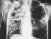zapalenie płuc - przyczyny, objawy i ryzyko
